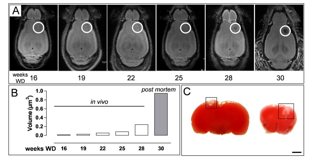 H4Fig. 5_Xanthomas increase in size over time and do not induce brain hypoxia H4Fig. 5_Xanthomas increase in size over time and do not induce brain hypoxia